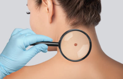 Dermatoonkologia